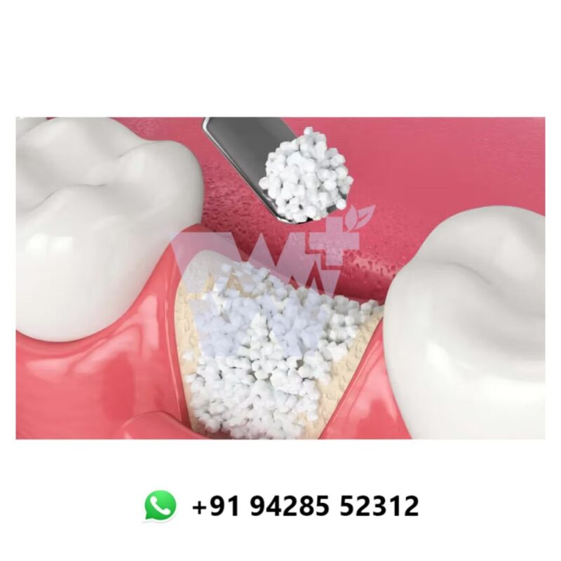 Ammdent Osteoden Bone Graft