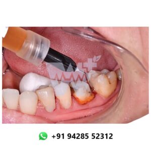 SafeEndo Smart Retract Liquid Hemostatic Agent