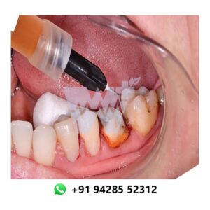SafeEndo Smart Retract Gel Hemostatic Agent