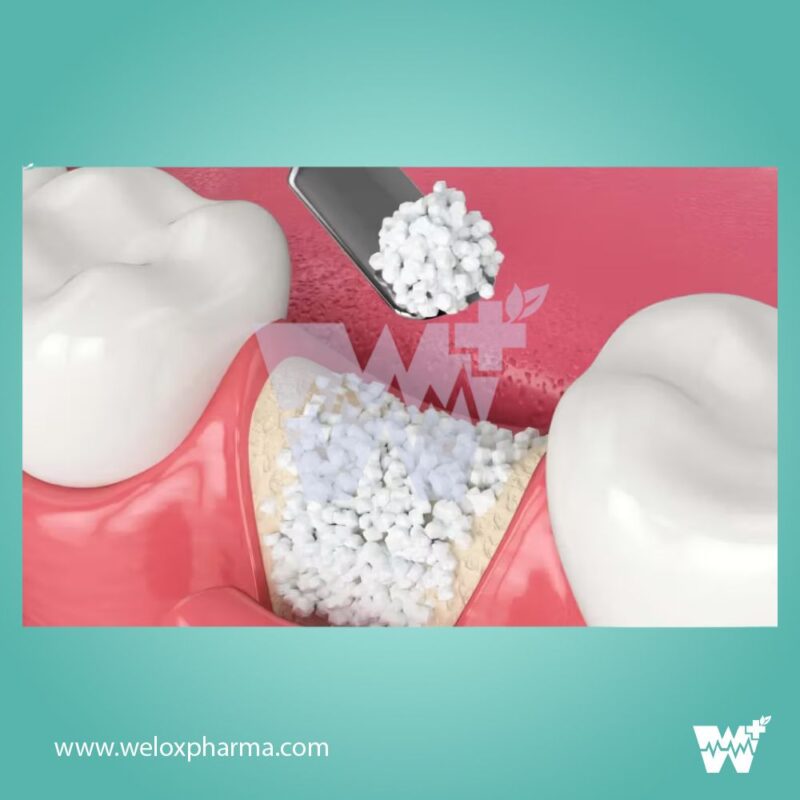 Ammdent Osteoden Bone Graft - Image 2